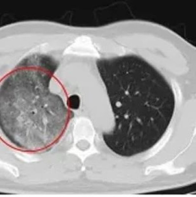 江苏确诊一例罕见传染病