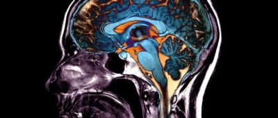 大脑衰老的5种方式：5万张脑扫描揭示潜在的损伤模式