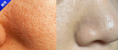 洗脸后多做这一步，毛孔竟然真的能“缩小”！（不是医美）