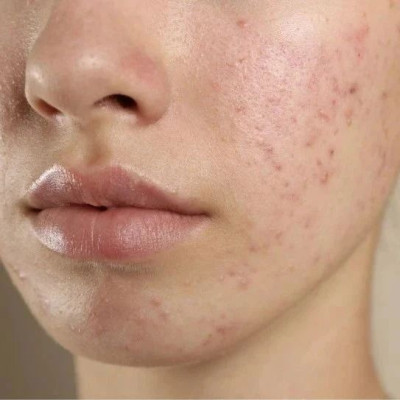 那些管不住手乱挤痘的人，后来都怎么样了……