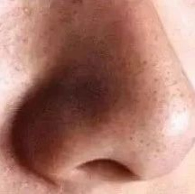 真惊了，天天洗脸，毛孔竟然还有这么多脏东西……