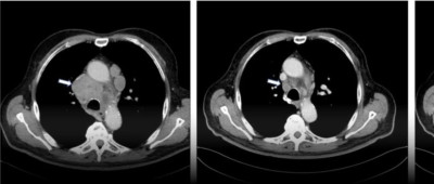 因为感染新冠，他的肿瘤缩小了
