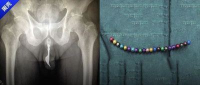 不要放进尿道里的东西：温度计、叉子、磁力珠、数据线、钉子……