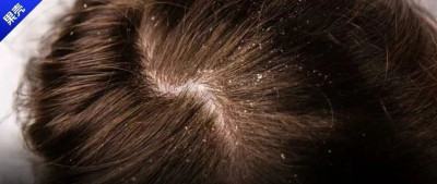 冬天千万别随便甩头！你的头皮屑会治服你......