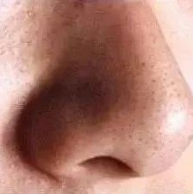 100次面膜都解决不了的黑头，竟然用ta“吸”出来了……