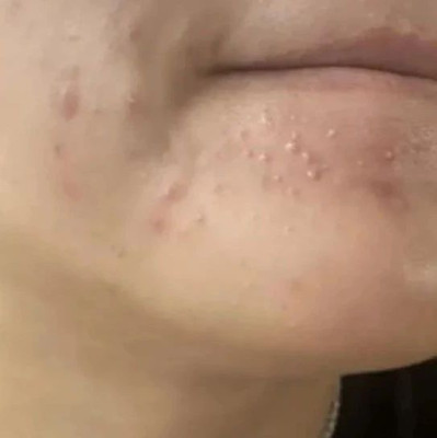 说真话 | 这样祛痘，相当于毁容式护肤