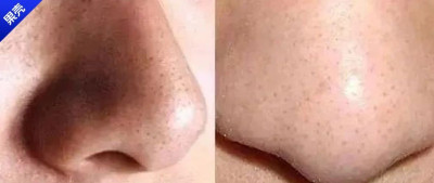 这个让毛孔越撑越大的行为，90%的人都逃不过……