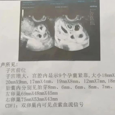 怀九胞胎女子，最终留下两胎
