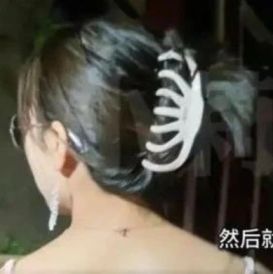 网红鲨鱼夹再伤人，医生紧急提醒