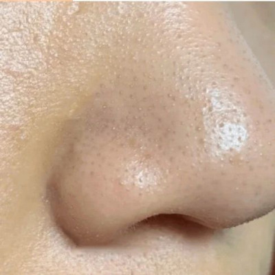 几千块都弄不干净的粗毛孔，竟然被我100块搞定了……