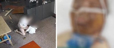 医生回应“钢丝球清创”，感动全网的“烧伤妈妈”最新情况→