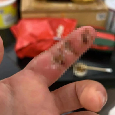 易被误诊的“自毁容貌综合征”