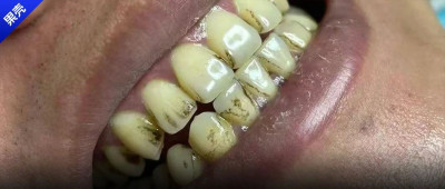 速来！一个简单省钱不伤牙的白牙小技巧（建议收藏）