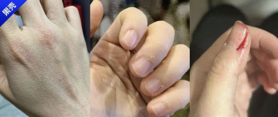 一出现倒刺就撕？住手！手皮真的不能乱撕……
