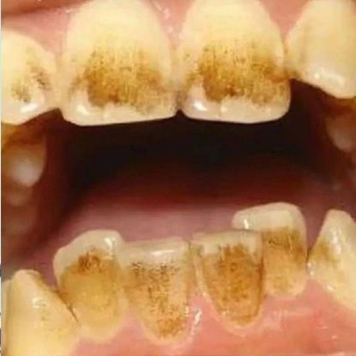 速来！一个简单省钱不伤牙的白牙小技巧（建议收藏）