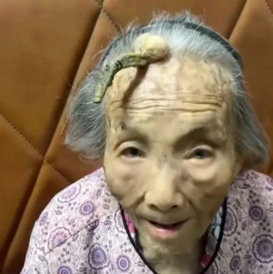 每日热问丨107岁老奶奶额头生出“长寿角”，这是什么情况？