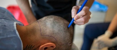 牛市来了，植发的春天也来了？丨智氪