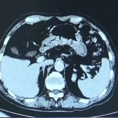 每周三顿确诊胃癌！医生：年轻人要警惕
